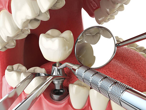 Best Emergency Dental Care for Broken or Chipped Teeth in Spinnerstown, PA